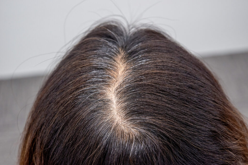 まずは共感と結論|「分け目が広がってきた…」その悩みは放置しない方がいい理由